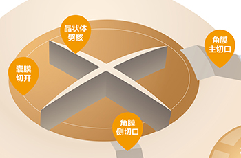 ICL晶体植入矫正手术
